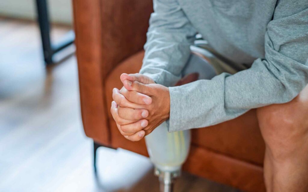 Legal Options For Loss of Limb or Amputation Injury Victims in FL? Call 305-390-4259